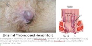 Pushing external hemorrhoids into anus